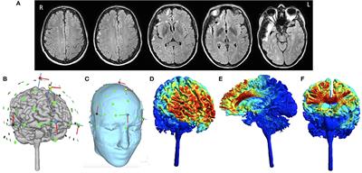 Case Report: Improving Verbal Retrieval Deficits With High Definition Transcranial Direct Current Stimulation Targeting the Pre-Supplementary Motor Area in a Patient With Chronic Traumatic Brain Injury